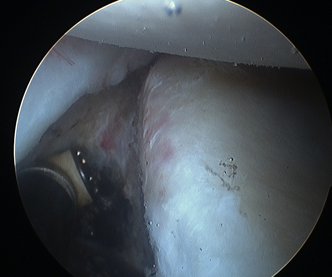 Shoulder Stabilisation Anterior Labral Mobilisation 2